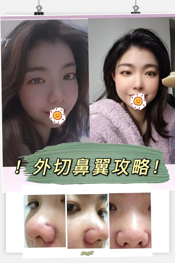 你有觉得自己鼻翼大吗?_圈子-新氧美容整形
