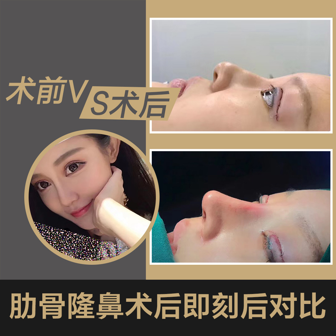 异体骨隆鼻后还可以用耳软骨修复么我做的异体骨效果非常不好非常翘