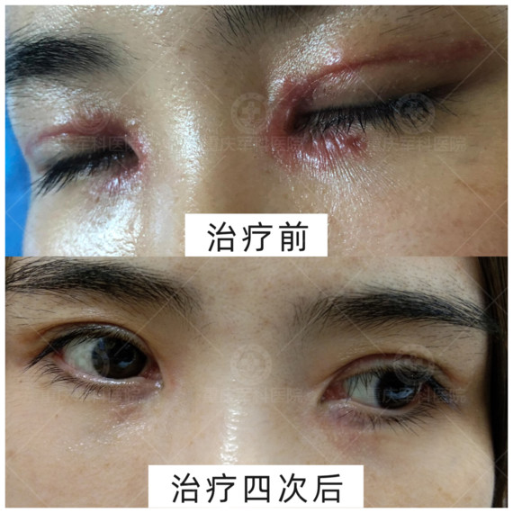 您好,双眼皮手术后一般均会有个疤痕增生的过程,只不_圈子-新氧美容