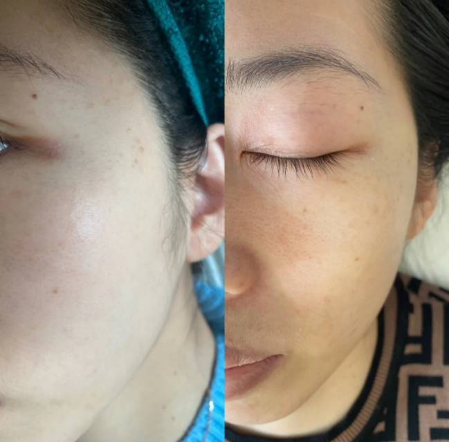 首先呢,超皮秒的效果我就不多说了,大家看完我的图就_圈子-新氧美容