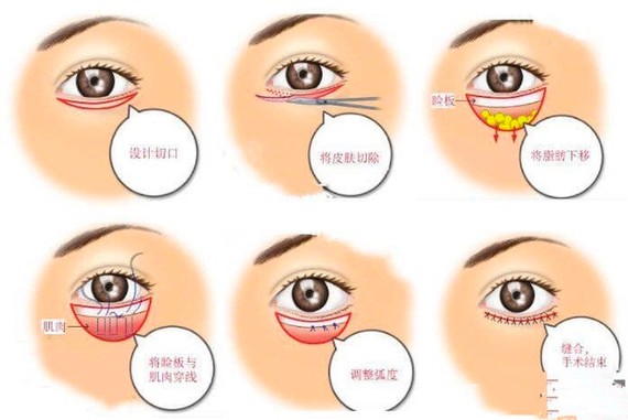 不过,外切法的手术效果虽然比内切明显,但容易造成下睑外翻和睑球分离