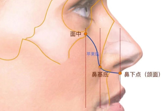 97鼻基底凹陷怎么办?