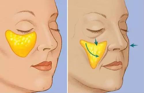 法令纹苹果肌下垂