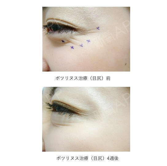 中眼尾斜下方出现的皱纹被称作乌鸦的足迹,此处是皱纹容易行程的部位