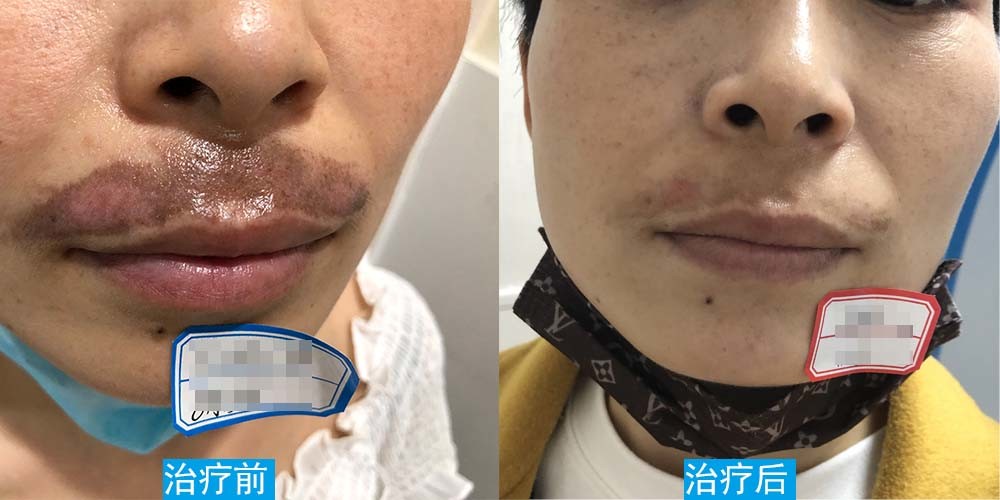 疤痕黑色素会消失吗