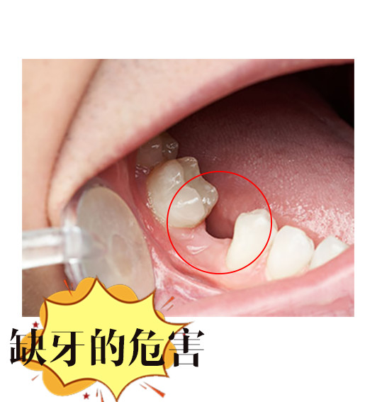 缺牙的危害:缺失了一颗牙齿不补,牙齿越掉越快当我们的牙齿脱落时