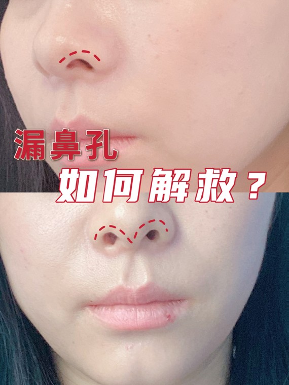 干货必看!73如何判断鼻孔外露?大多_圈子-新氧美容整形