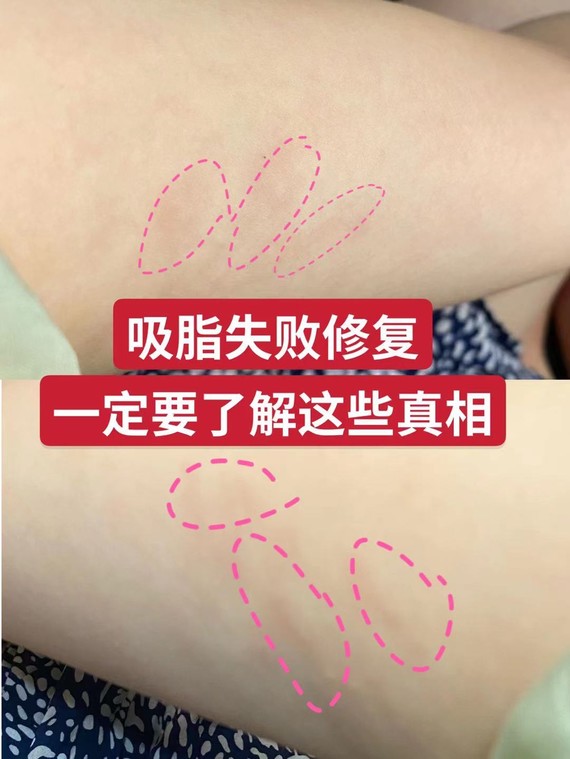 腰腹环吸失败图片