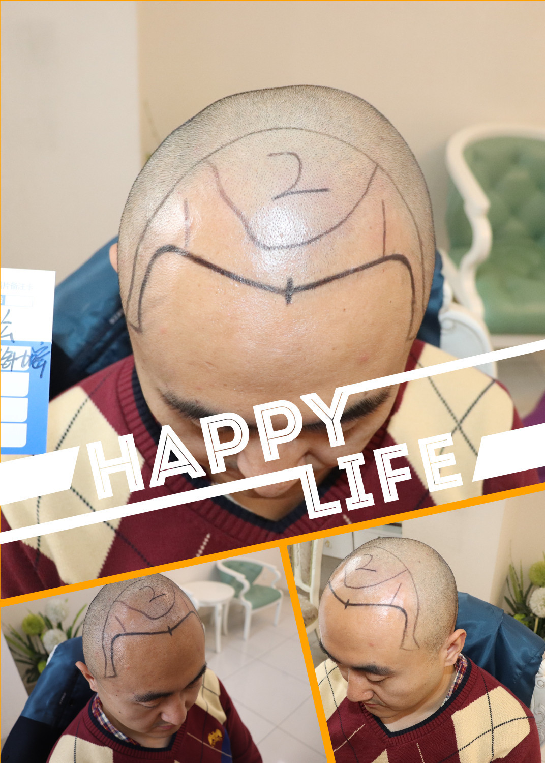 【大麦微针植发—术前设计】饱受脱发困扰多年,我最后下定决心