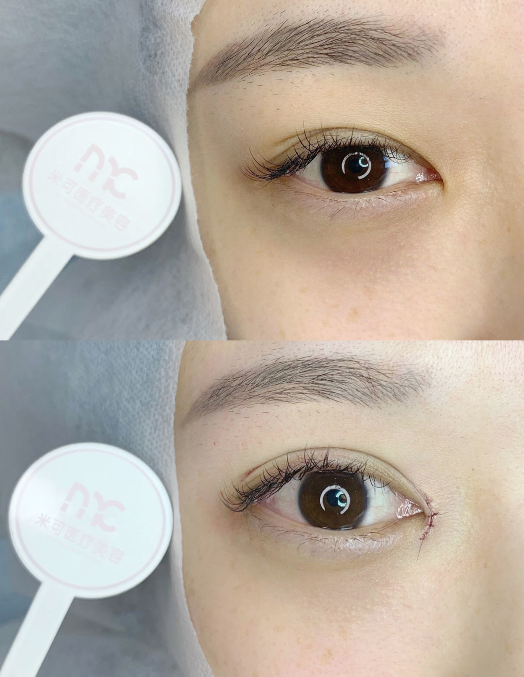 无痕双眼皮 开眼角的即刻效果双眼皮和开眼角是著名的_圈子-新氧美容