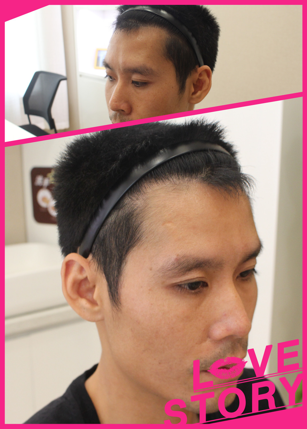 手术已经快三个月了,取发区的头发恢复的已经很好了,已经没怎么脱发了