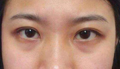 结构型 结构型的黑眼圈主要是因为 衰老导致的组织结构改变,面部组织