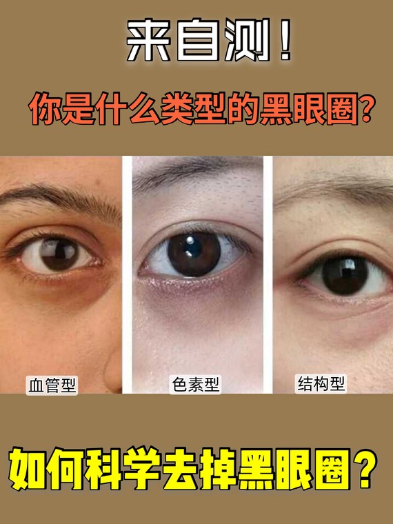 黑眼圈类型对照图图片