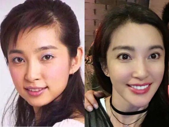 整牙后对侧脸的改观明显.#哪种气质的人更受欢迎?