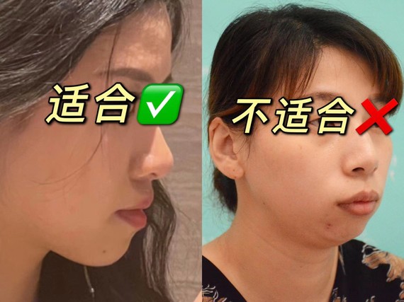 很多人下巴都比较短小,一个好看的下巴能够让脸型更好_圈子-新氧美容