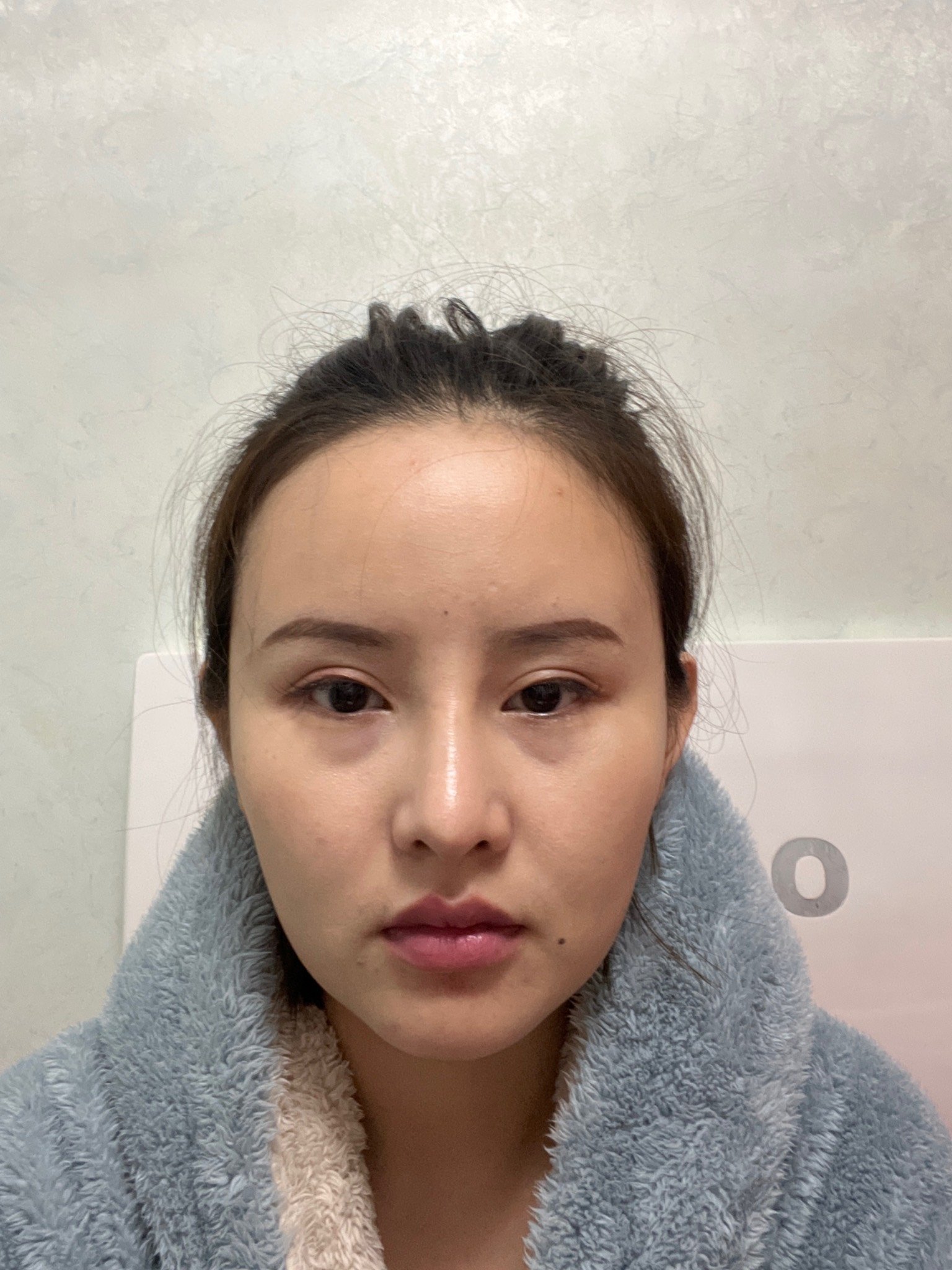 我想改善的部位:额头 颧骨颧弓