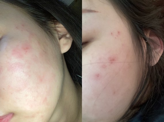 刷酸焕肤|"刷酸护肤"有门槛当心美容变毁容