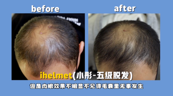 第二位小志,脱发程度3级.