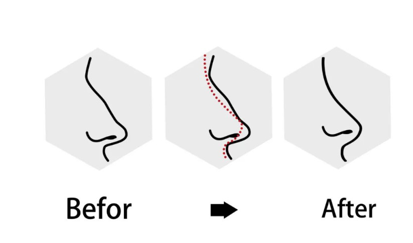 什么情况要做鼻修复?关于鼻修复你一定得知道这5件事！