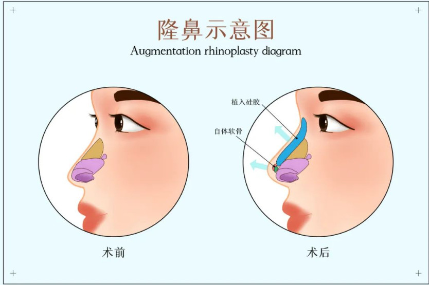 什么情况要做鼻修复?关于鼻修复你一定得知道这5件事！