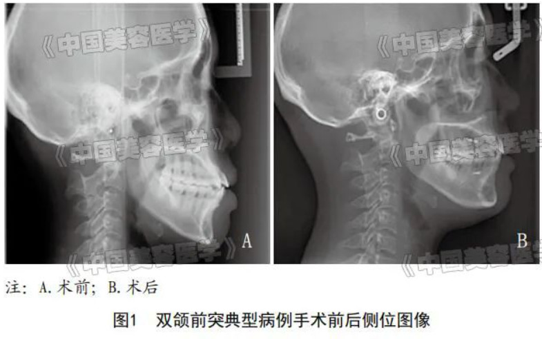 微种植体支抗辅助治疗双颌前突的临床效果分析