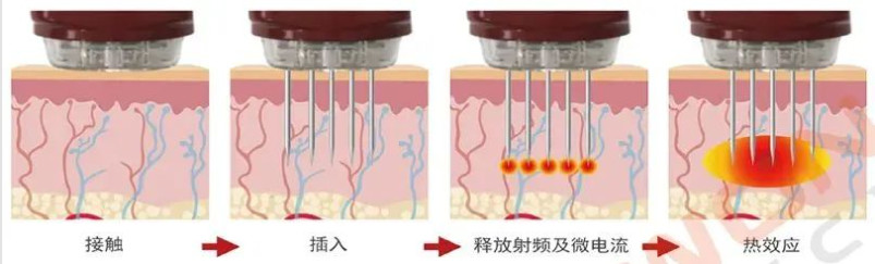 黄金微针：重返皮肤的“黄金”时代丨科普篇