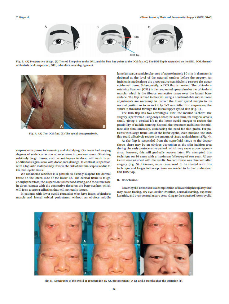 Review | 下睑退缩治疗的系统综述及真皮-眼轮匝肌悬吊瓣的修复应用
