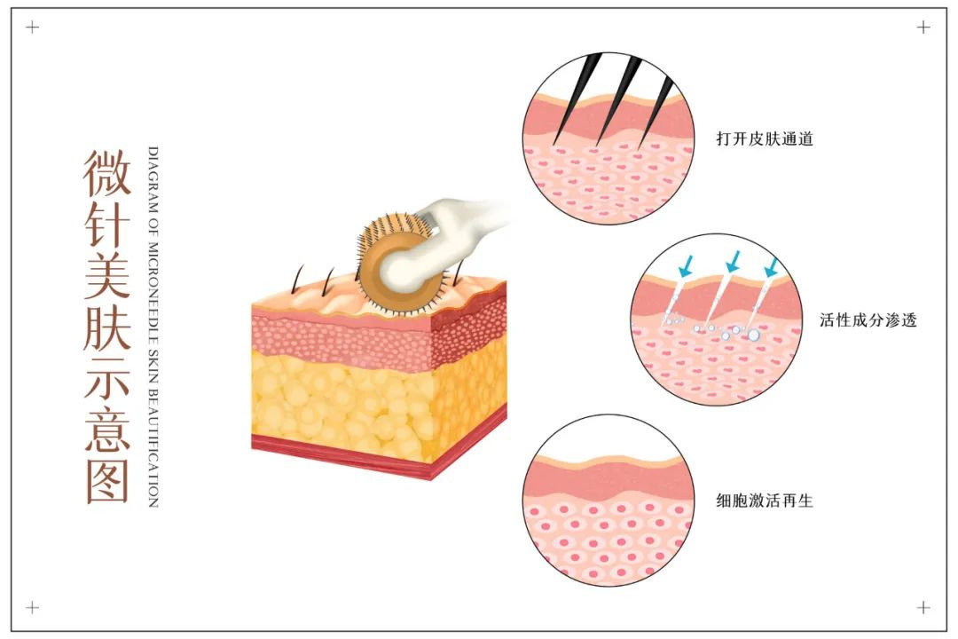 抗衰除皱、提升紧致，“针”出你的美，做完黄金微针需要注意什么？