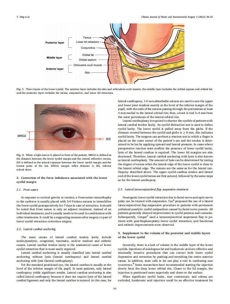 Review | 下睑退缩治疗的系统综述及真皮-眼轮匝肌悬吊瓣的修复应用