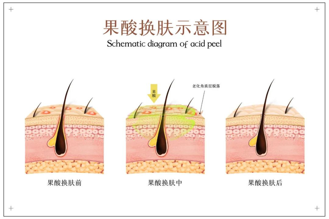 毛孔粗大是不可逆转的吗？光子、点阵、果酸、肉毒素哪种适合我？