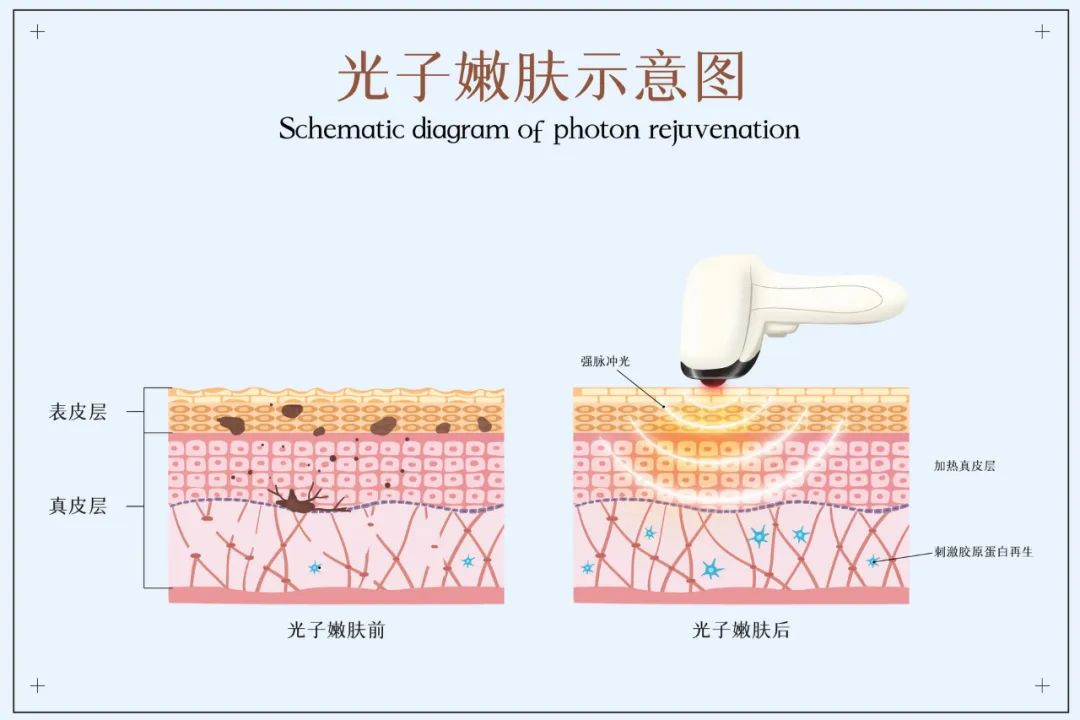 毛孔粗大是不可逆转的吗？光子、点阵、果酸、肉毒素哪种适合我？