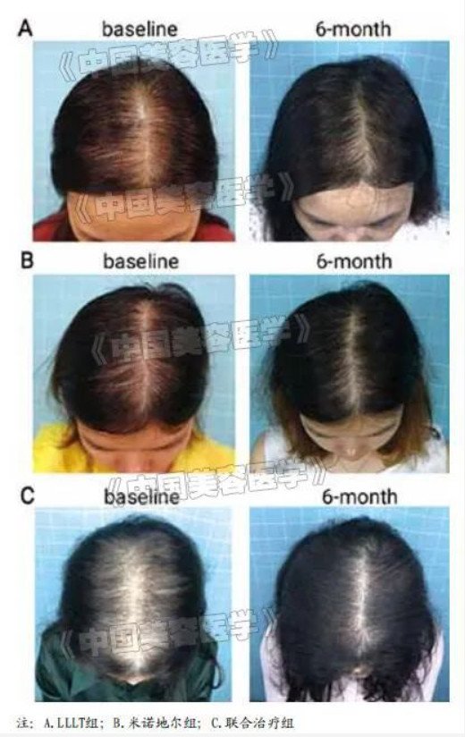 皮肤美容 | 低能量激光治疗女性型脱发的随机对照临床研究