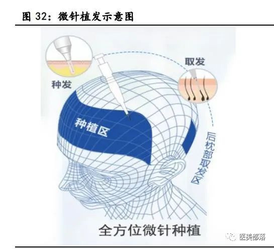 热点 | 植发：