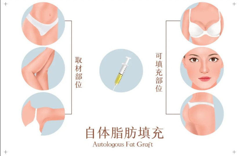 做完鼻基底填充能年轻10岁以上？鼻基底填充和隆鼻能不能一起做？