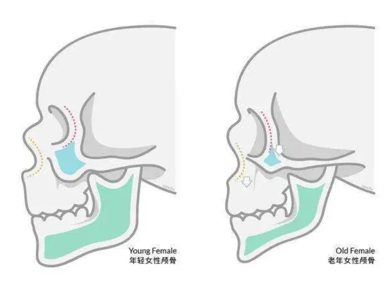 骨整形浪潮 卡洛尔邦珊瑚骨领启骨再生领域新增长