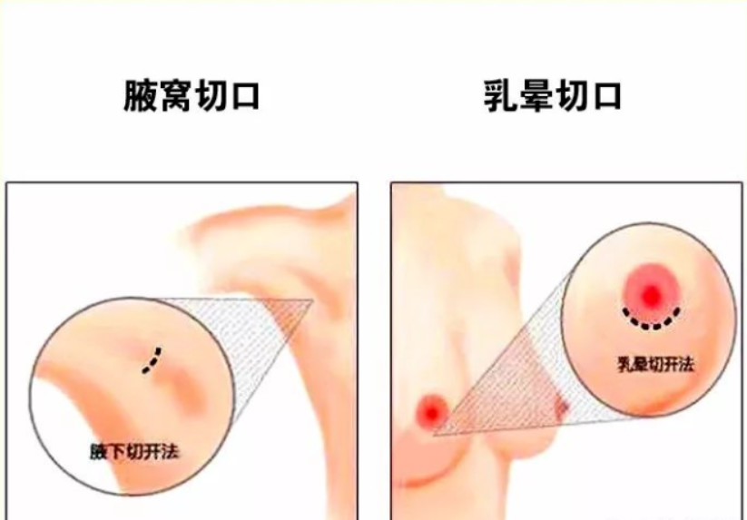 王宇鹏：假体隆胸术原理及切口设计丨科普篇