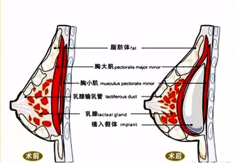 王宇鹏：假体隆胸术原理及切口设计丨科普篇