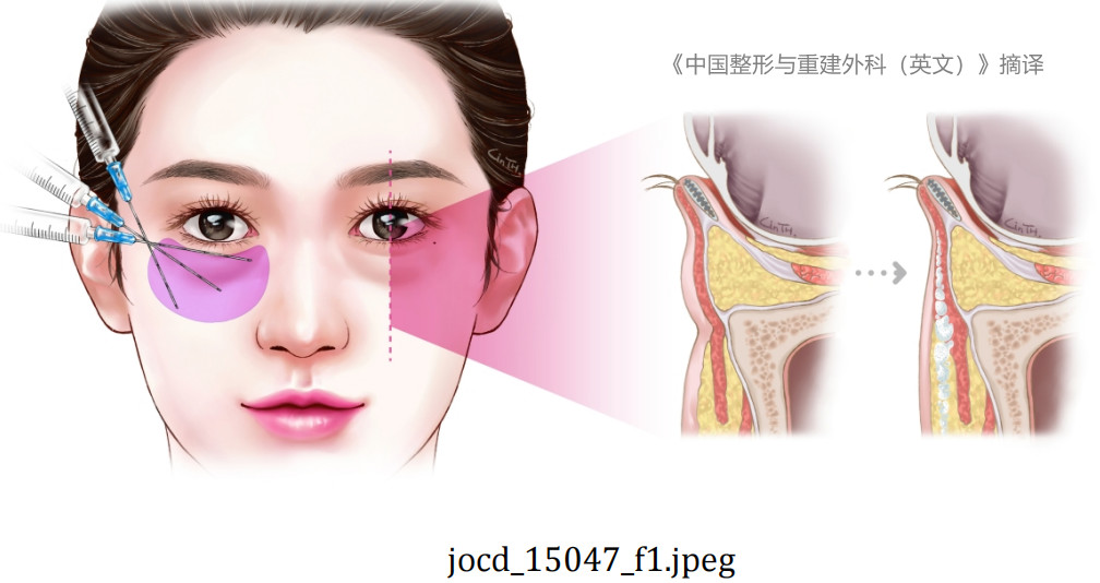 聚乳酸材料在亚洲患者下睑年轻化中的应用