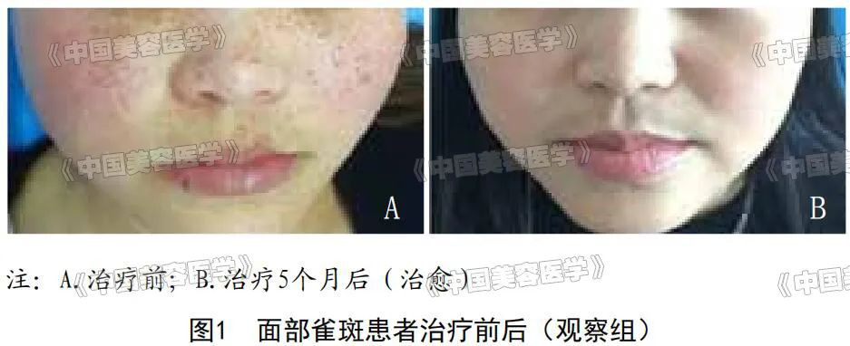 皮肤美容 | CC光与IPL治疗面部雀斑疗效对比观察