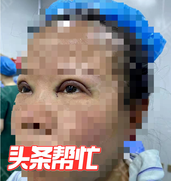 湖南女子称割双眼皮后4个月总瞪眼，医院回应：可以鉴定