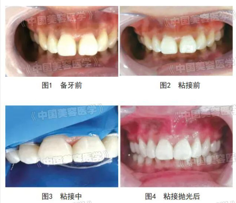 齿科美容 | 3M Single Bond Universal粘接系统对前牙E-max铸瓷贴面修复的远期疗效观察