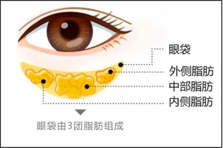 张新军：完整保留眶隔膜及脂肪在眼袋整形术中的应用丨专业视点