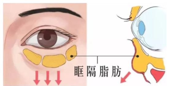 张新军：完整保留眶隔膜及脂肪在眼袋整形术中的应用丨专业视点