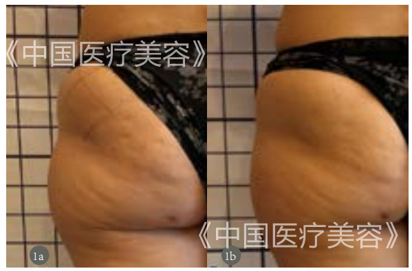 【美容外科】体外冲击波结合穴位埋线对改善脂肪团的疗效观察