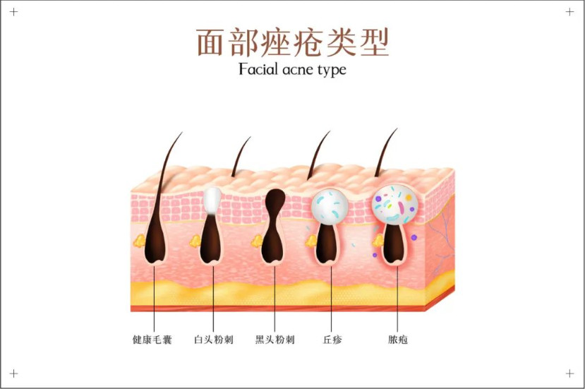 这些方法消灭痘坑、痘印，带你离开“月球表面”！