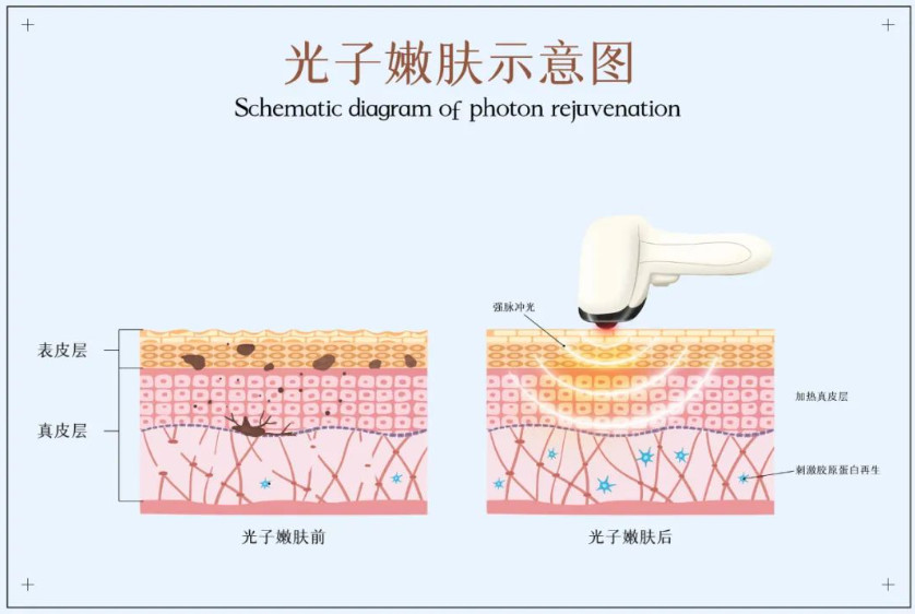 光子嫩肤治疗红血丝和雀斑的效果怎么样？治疗后如何护理皮肤？