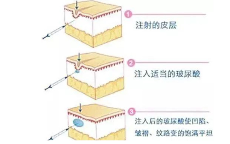 你的脖子比脸更显老，出现颈纹该怎么去除？丨科普篇