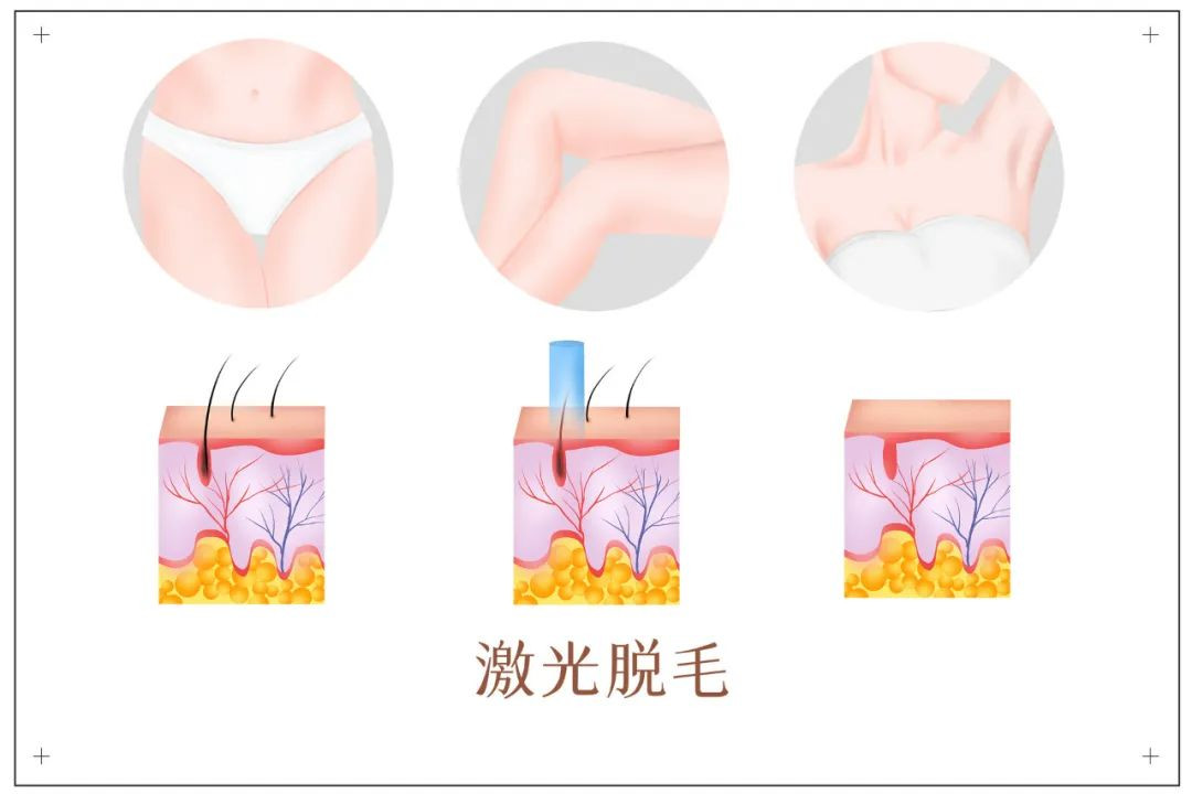 光子嫩肤、激光脱毛、水光针，这些平价轻医美便宜效果好！