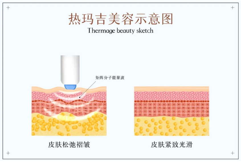 抗衰扛把子热玛吉，好评率仅66%？到底值不值？