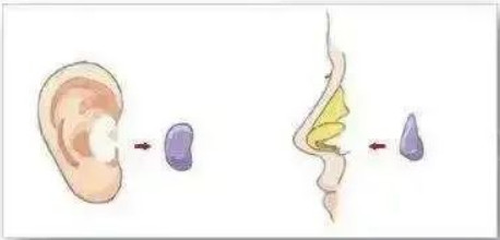 耳软骨（自体）隆鼻的7大特点丨科普篇